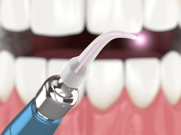 Illustration of laser dentistry at Tatum Pediatric Dentistry in Scottsdale